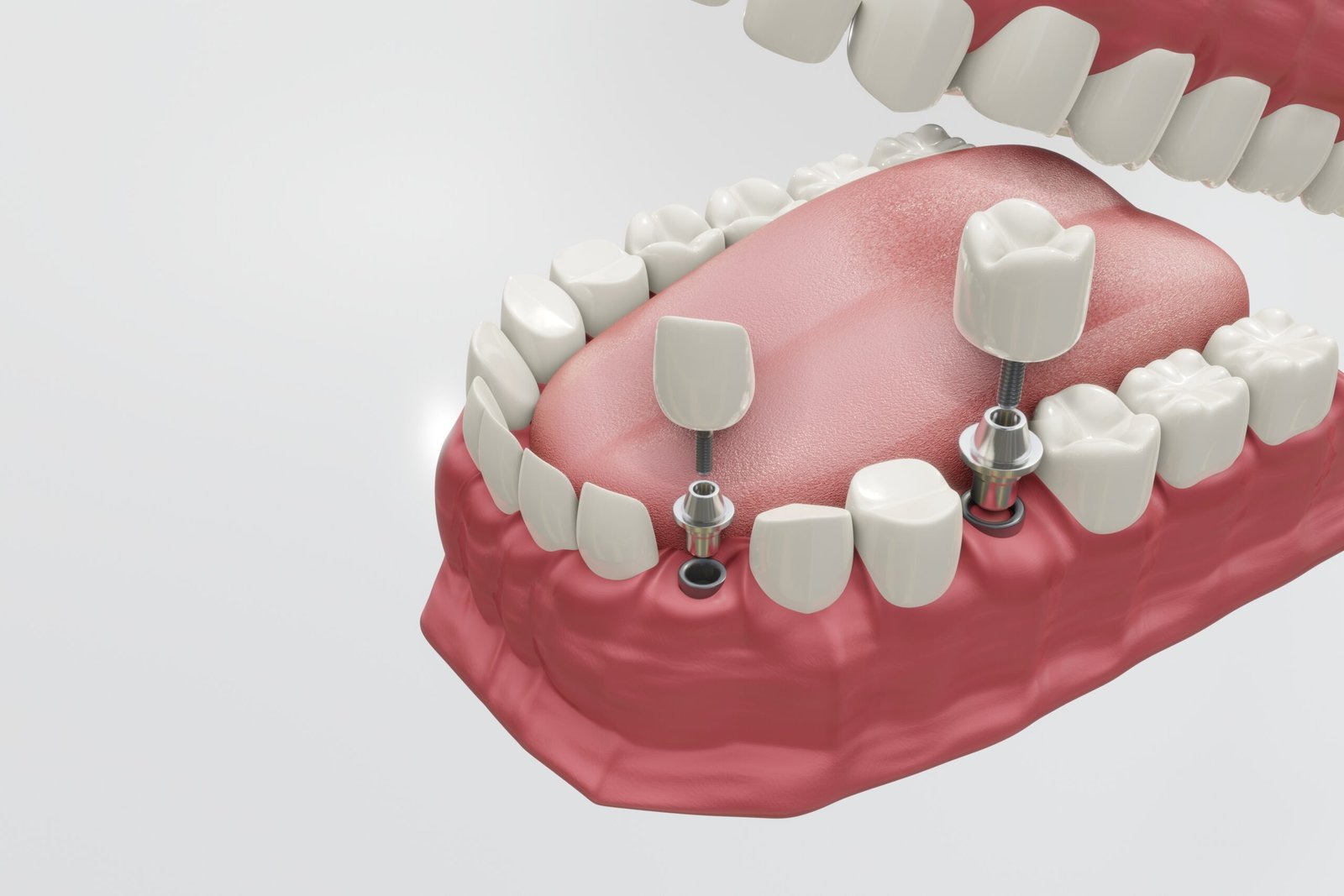 Dental Implants Treatment Procedure Image description